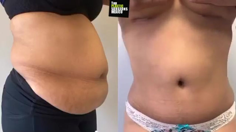 TUMMY TUCK + 360°LIPO